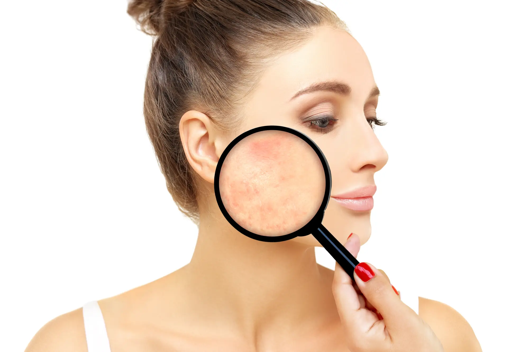 Acne, Rosacea and Redness patient ready for treatment at Biltmore Dermatology